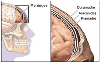 MENINGITIS TUBERKULOSIS